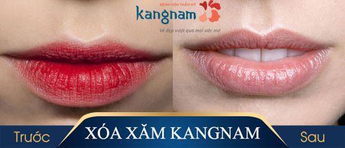 Hình ảnh xóa xăm môi Kangnam