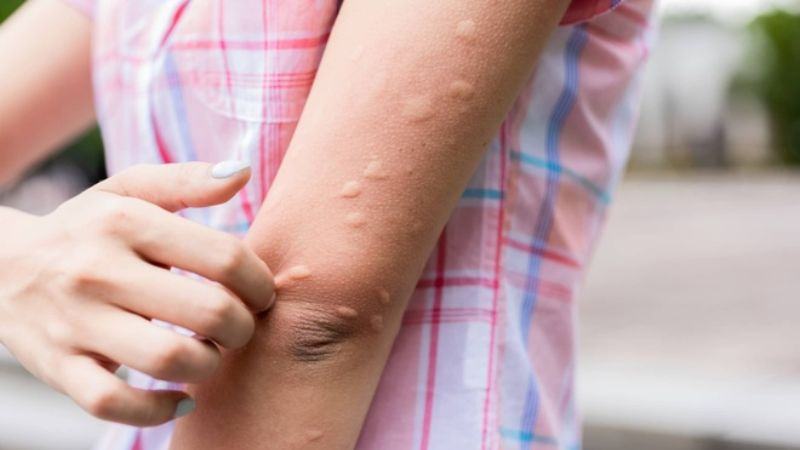 Chăm sóc vết muỗi đốt ở trẻ như thế nào?