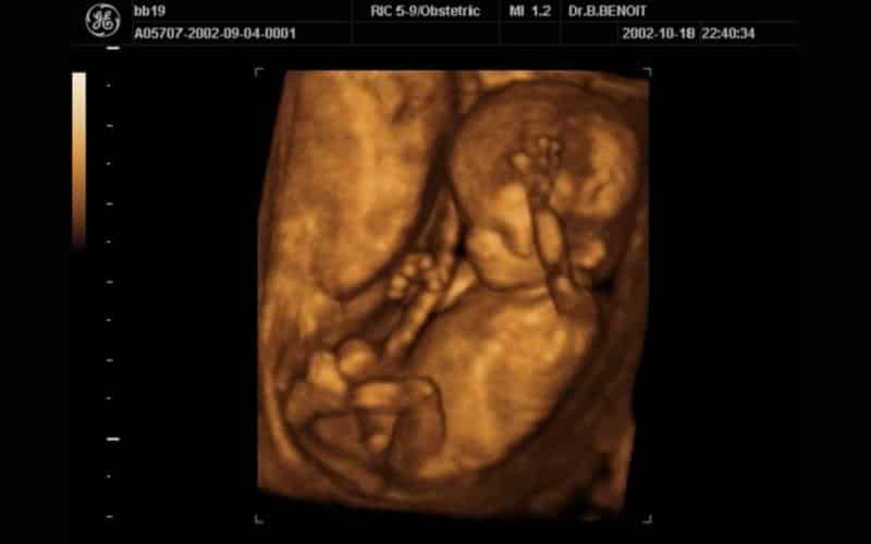Hình ảnh siêu âm thai nhi 16 tuần tuổi.  (Ảnh: Internet sưu tầm)